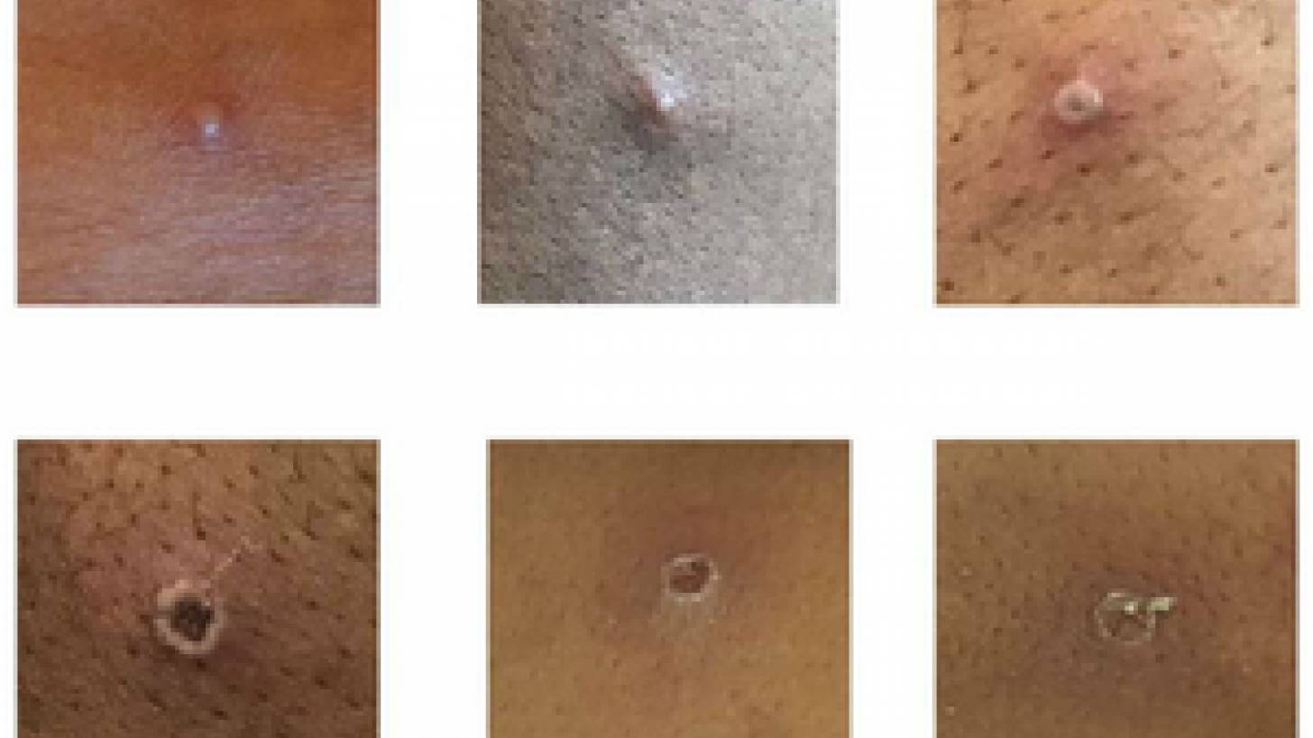 photos of monkeypox