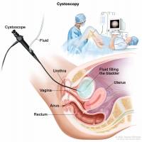 bladder cancer