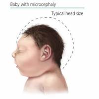 Zika and Microcephaly