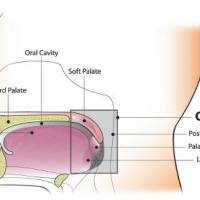 throat cancer vaccine